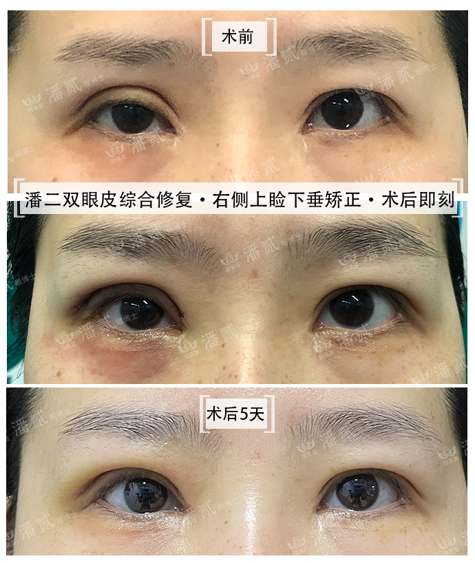 双眼皮术后恢复不一致正常吗,双眼皮术后看着不对称