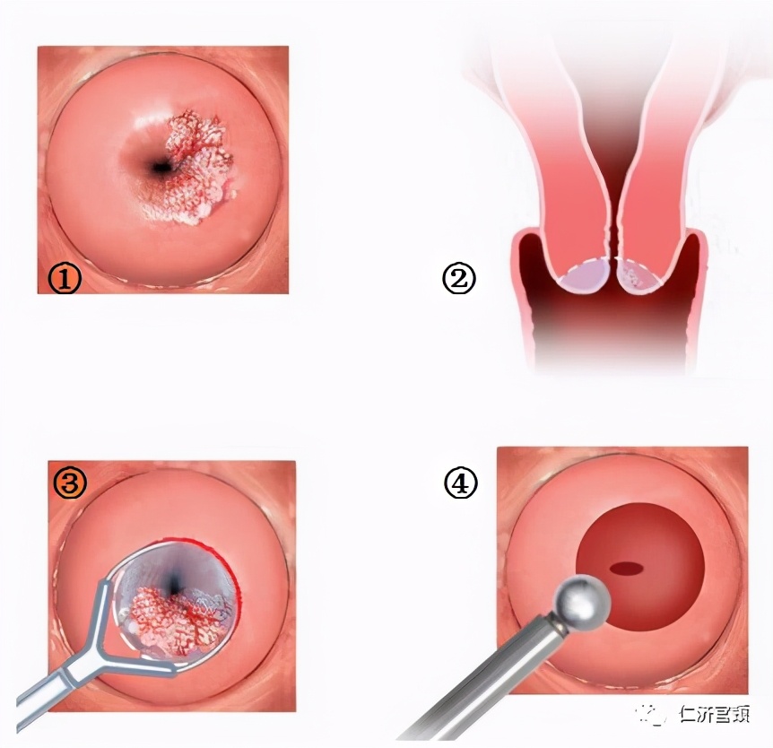 leep手术疼吗,leep手术后出血多久