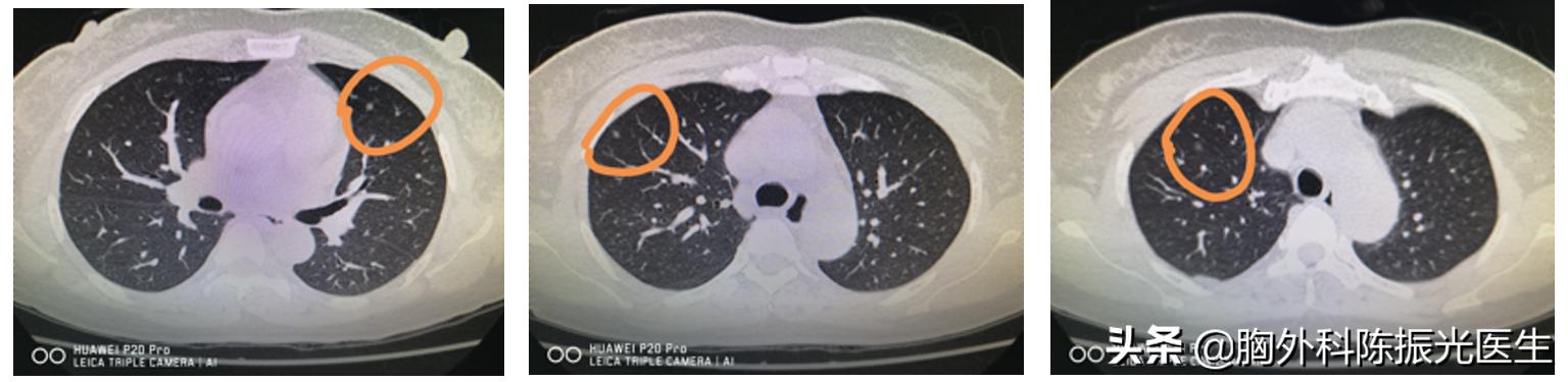 有肺结节可以在肺俞做艾灸吗,肺结节和吸入艾灸烟有关系吗