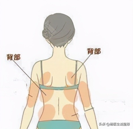 吸脂手术有哪几种类型,吸脂手术很微创