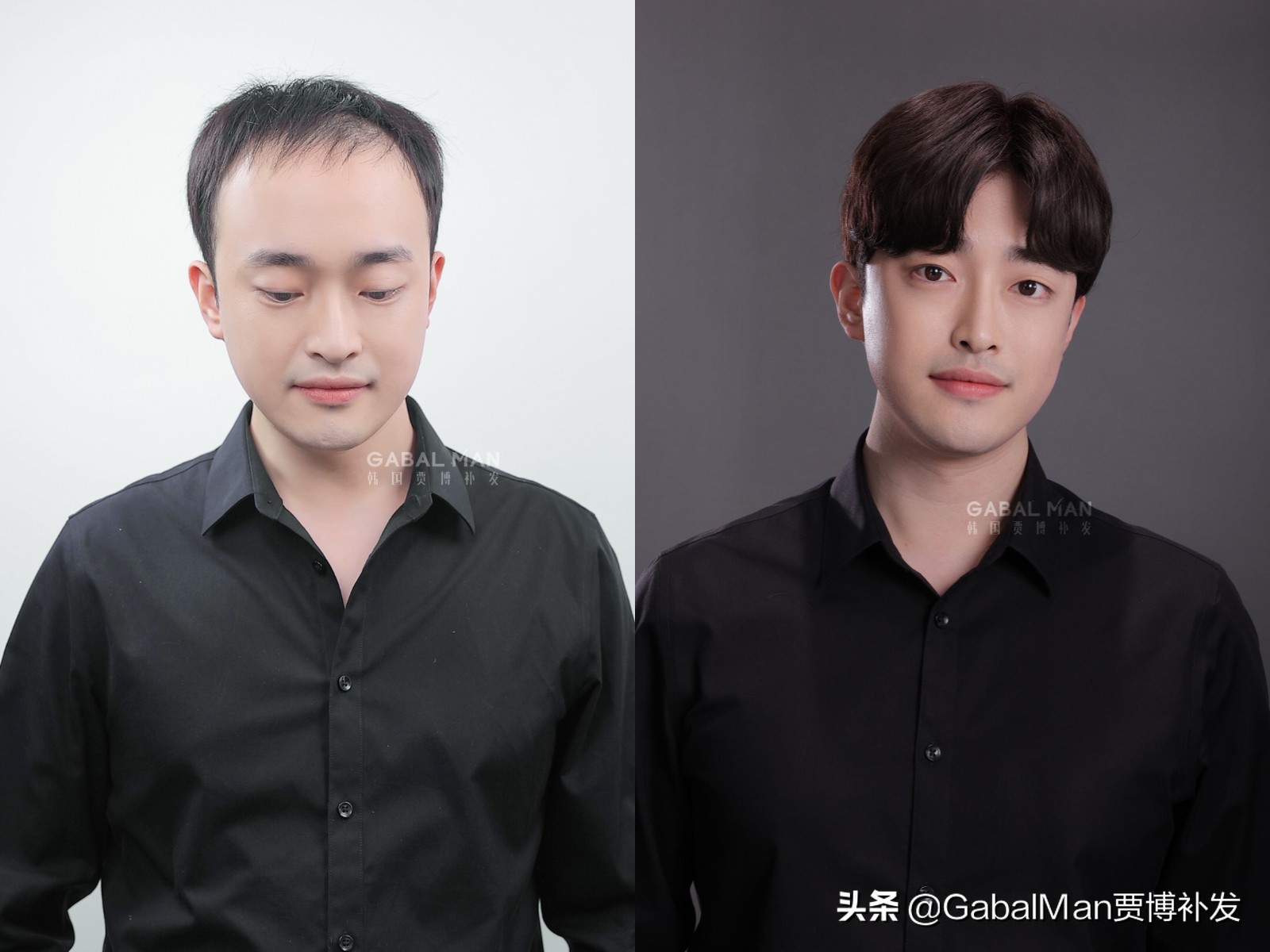 一招教你解决发际线高,发际线过高怎么拯救