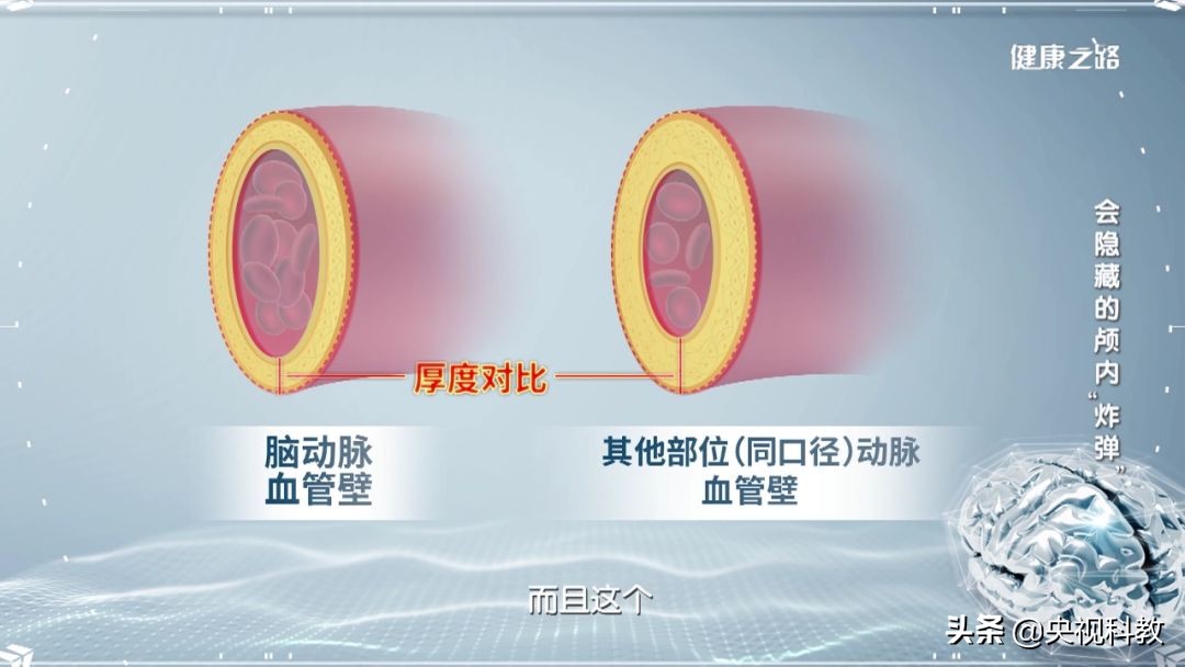 脑动脉瘤能吃腌制食品吗,过度食用腌制食品