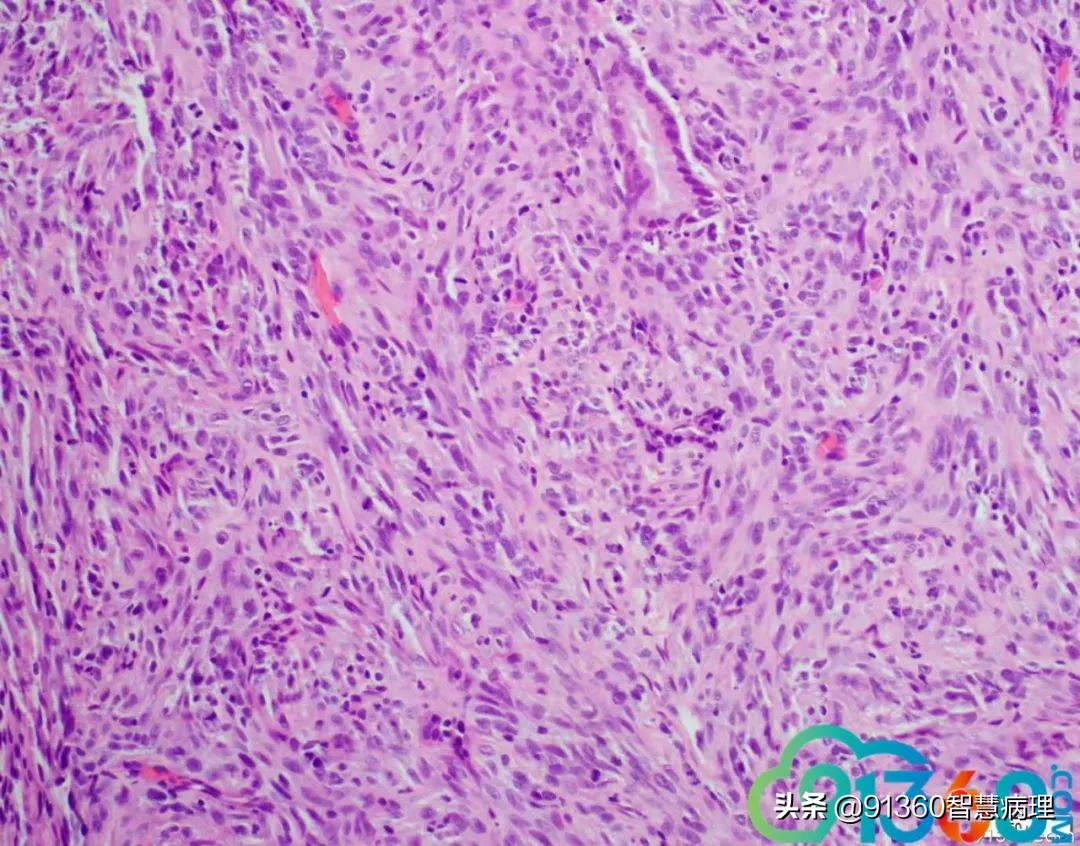 宫颈腺癌silvaa型严重吗,宫颈腺癌silvab型复发率高吗