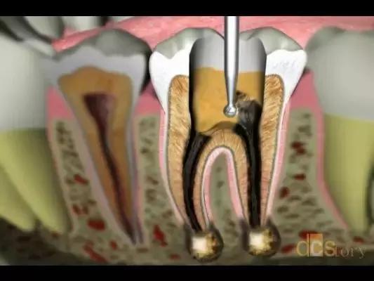 不做根管治疗直接补牙有什么危害,牙疼根管治疗后还疼什么原因