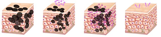 贝克氏母斑是皮秒好还是超皮秒好,皮秒跟超皮秒蜂巢皮秒有什么区别