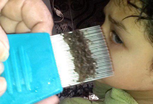 去头发虱子与虱子卵最有效方法,去除头上虱子和虱子卵最好小窍门