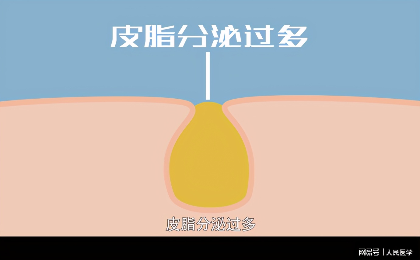 脸上出现像针孔大小的坑,脸上有很多像毛孔一样的坑怎么办