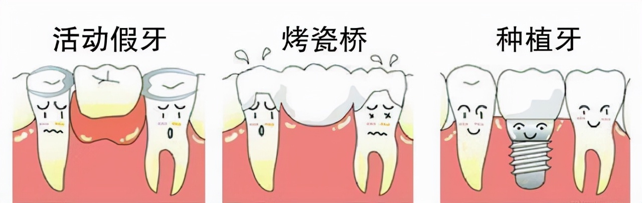 牙齿松动最佳补救方法种牙,牙齿松动怎么保护