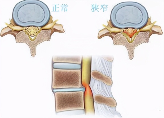 颈椎椎管狭窄手术成功率,2020年胸椎管狭窄手术成功率
