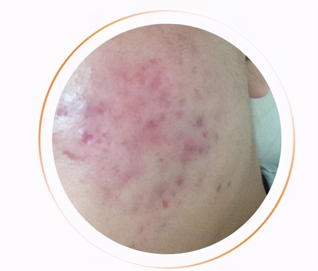 祛除痘坑痘印药膏,男士痘印痘坑怎么去除