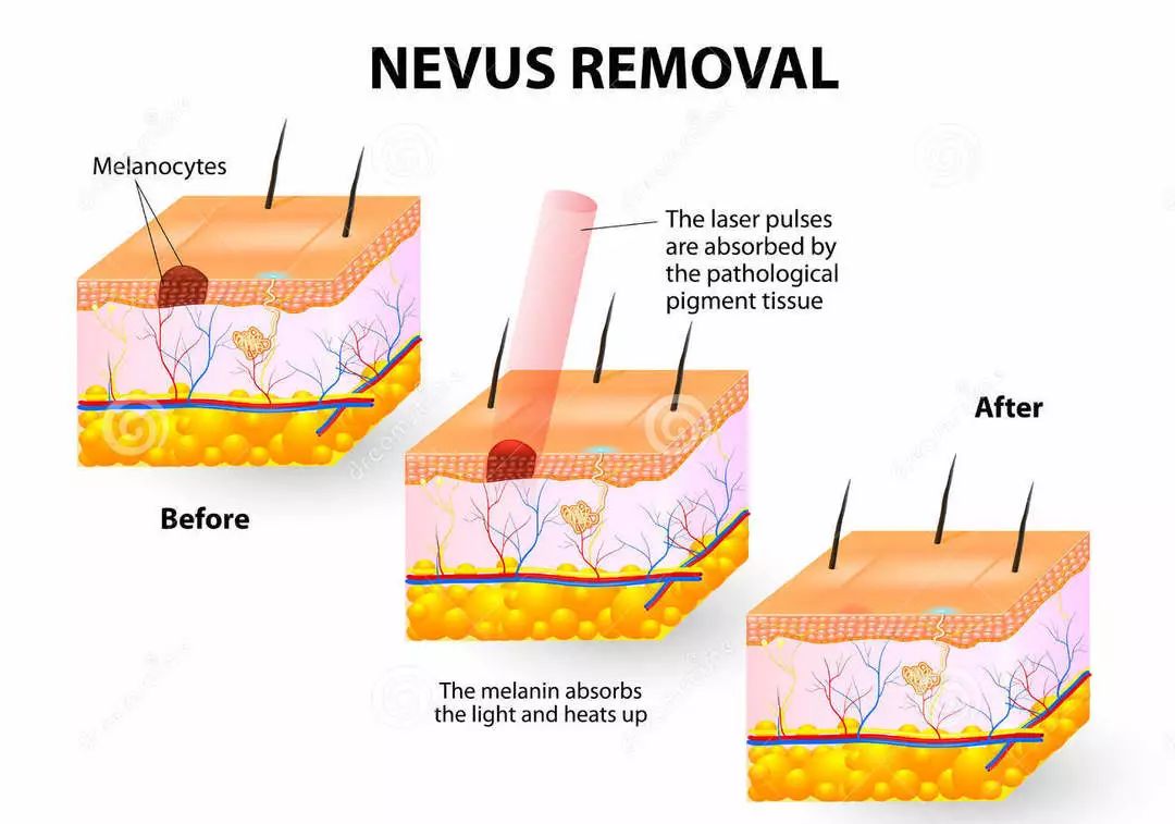 脸上痣多怎么去除简单方法,脸上痣太多怎么在家去除