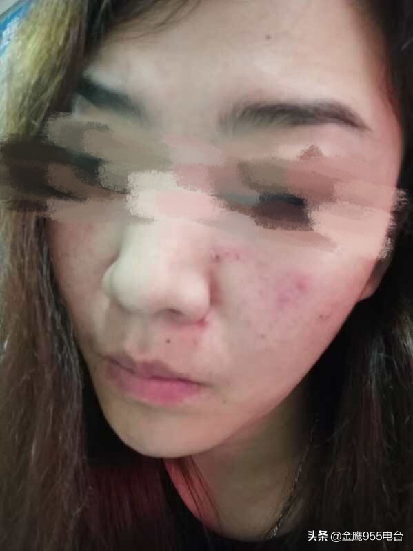 800元祛痘竟毁容,祛痘毁容800元