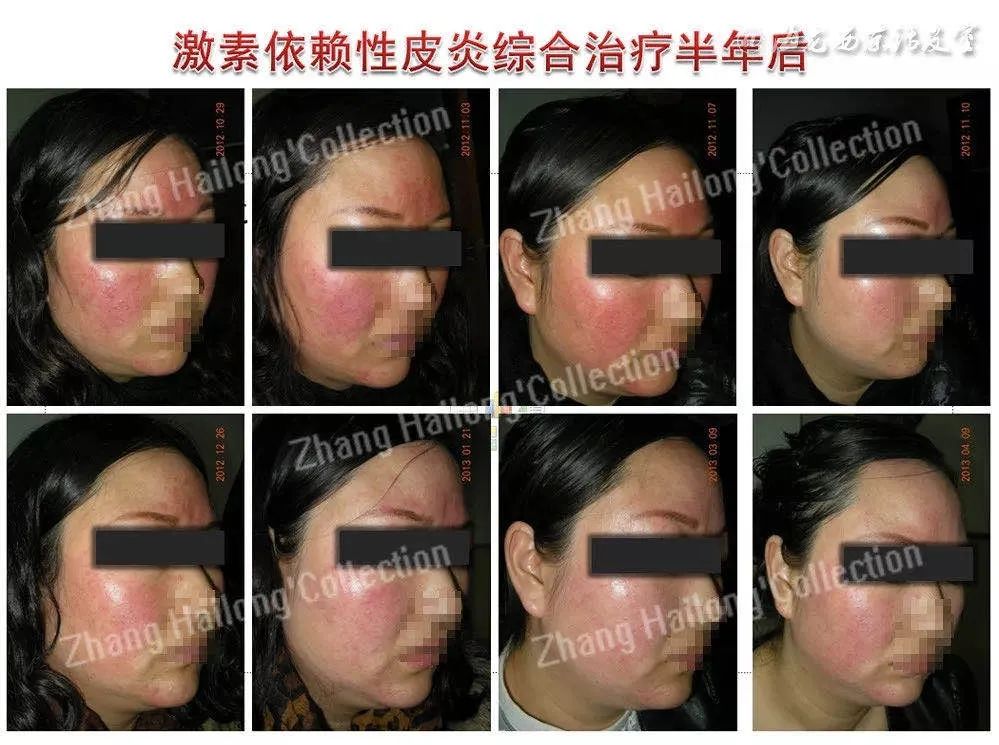 激素依赖性皮炎能自愈吗,激素依赖性皮炎能根除吗