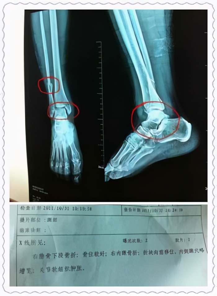 脚丫肿得很疼怎么缓解,脚丫子突然肿胀疼