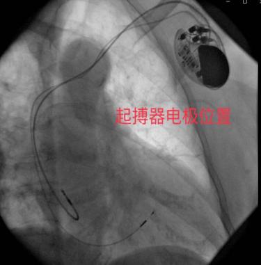 心脏起搏器植入,缓慢性心律失常起搏器植入术