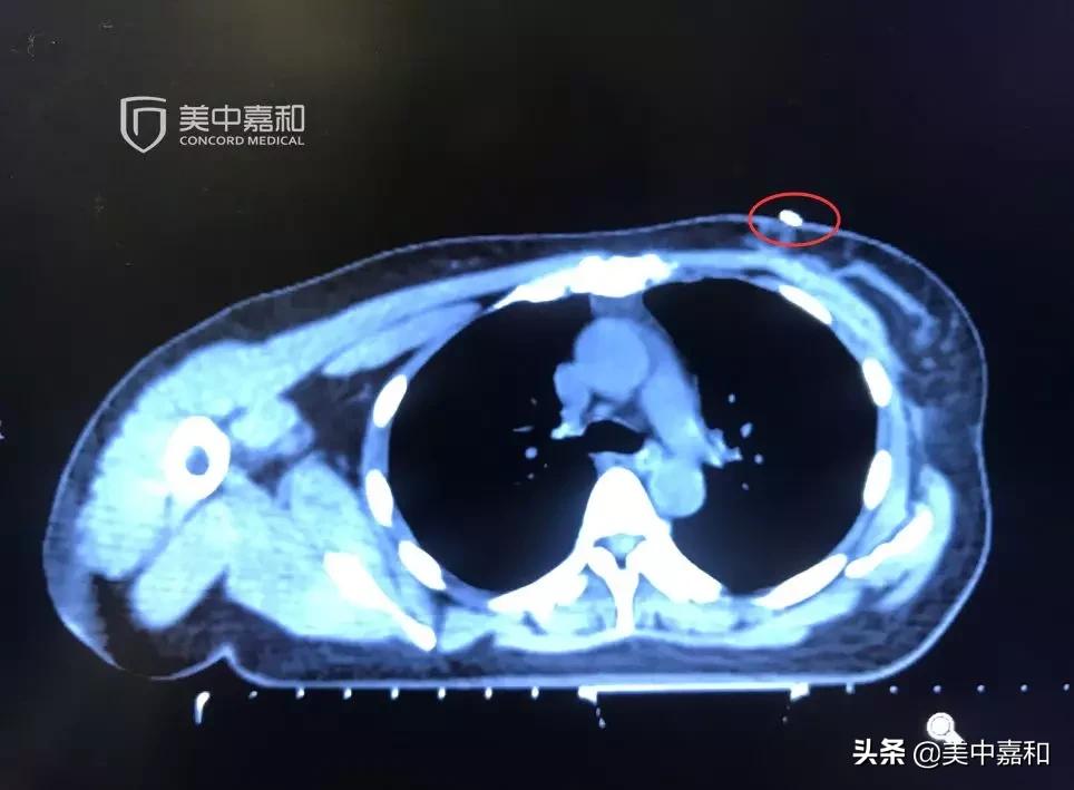 乳腺癌保乳术后怎么保养,乳腺癌保乳术后用哪种放疗最好