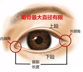 做外眼角改变到底大不大,开外眼角的手术后的图片