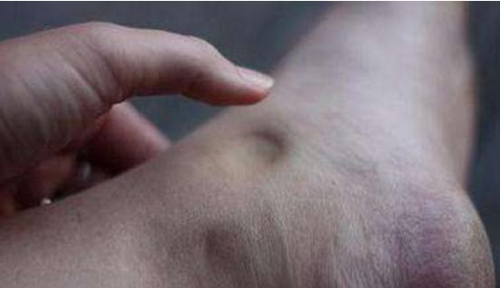 身体湿重吃什么药,身体又痒又湿