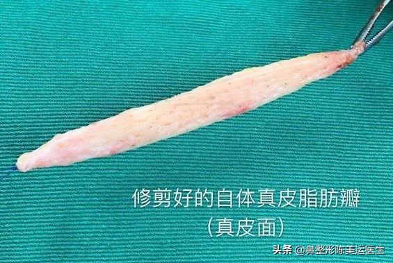 假体隆鼻后鼻子变歪该如何处理,假体隆鼻透光如何处理