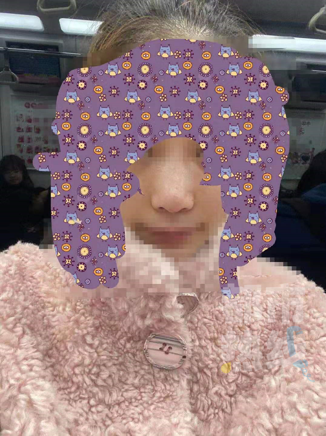 女子花5万隆鼻结果鼻梁歪斜,西安女子隆鼻后鼻子变歪