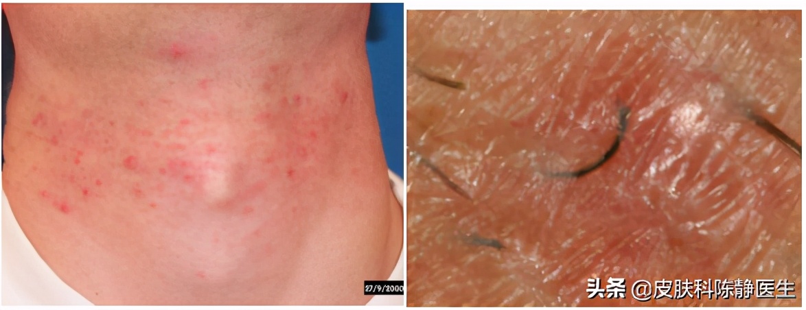 刮胡子毛囊炎凸起硬疙瘩怎么消除,刮胡子起小红点的毛囊炎怎么办