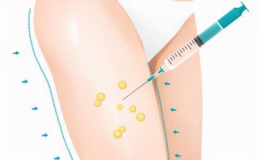 大腿抽脂最多可以抽多少脂肪,大腿抽脂能瘦多少厘米