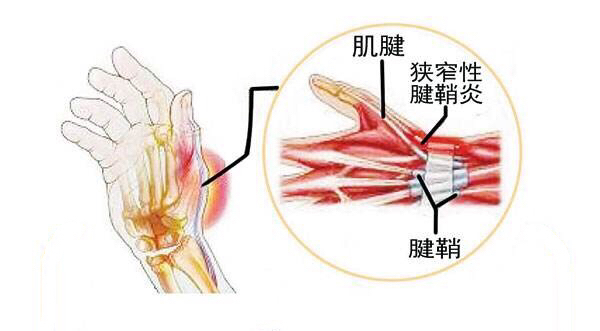产后抱娃手臂手指酸痛无力咋办？4个方法、2个窍门帮你解除疼痛