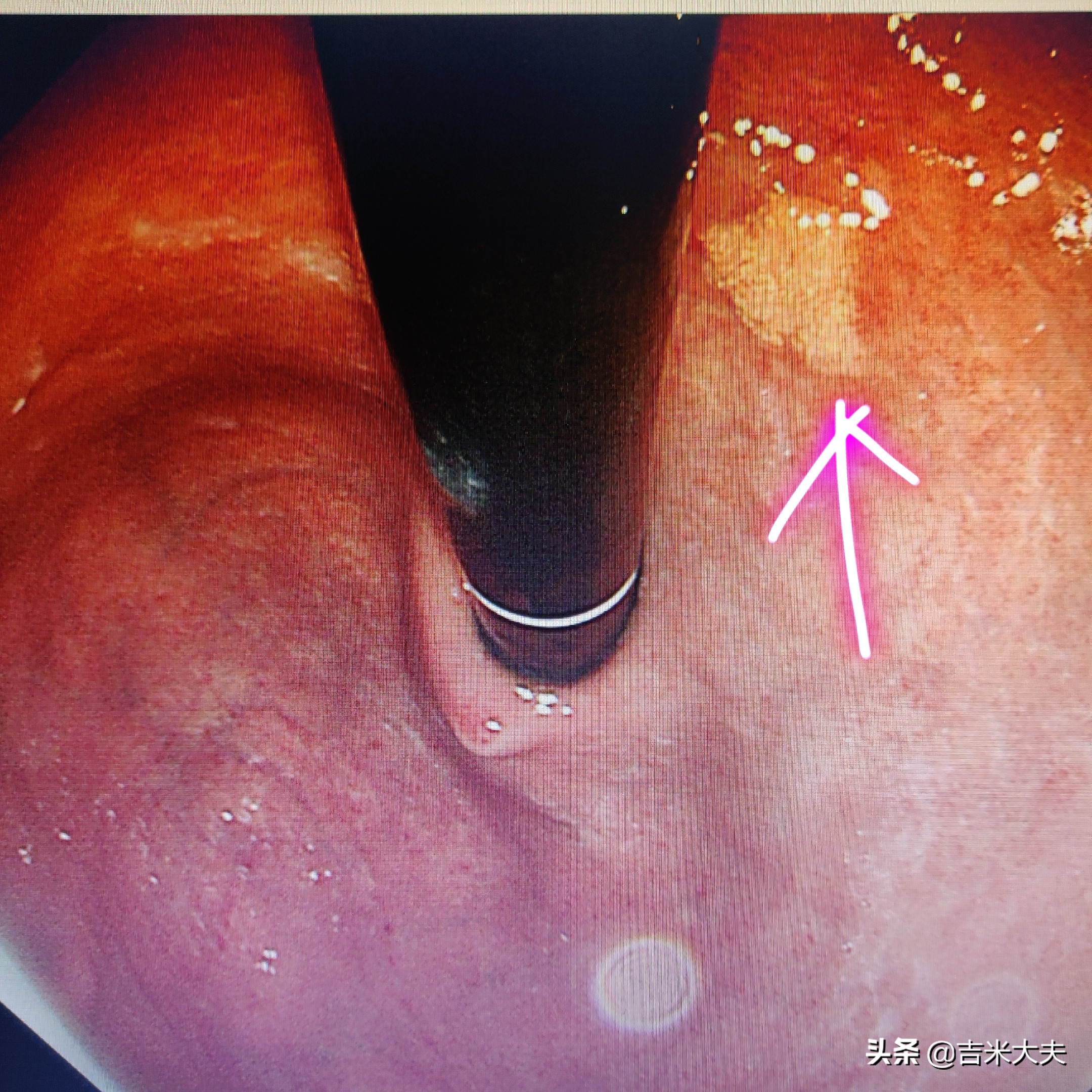 做胃镜胃里长疙瘩就是胃癌吗,做胃镜查出小息肉切除了有事吗