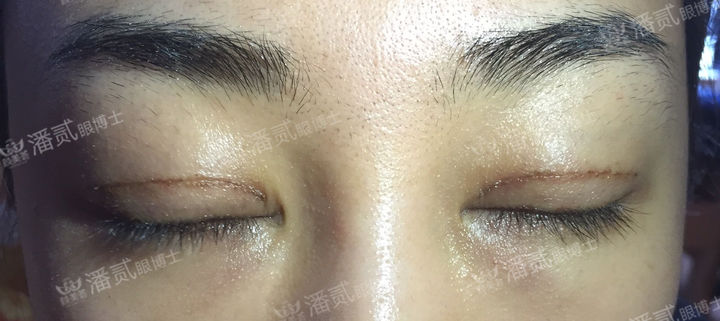 原来双眼皮不好看有必要继续割吗,割双眼皮是不是越修复越难看