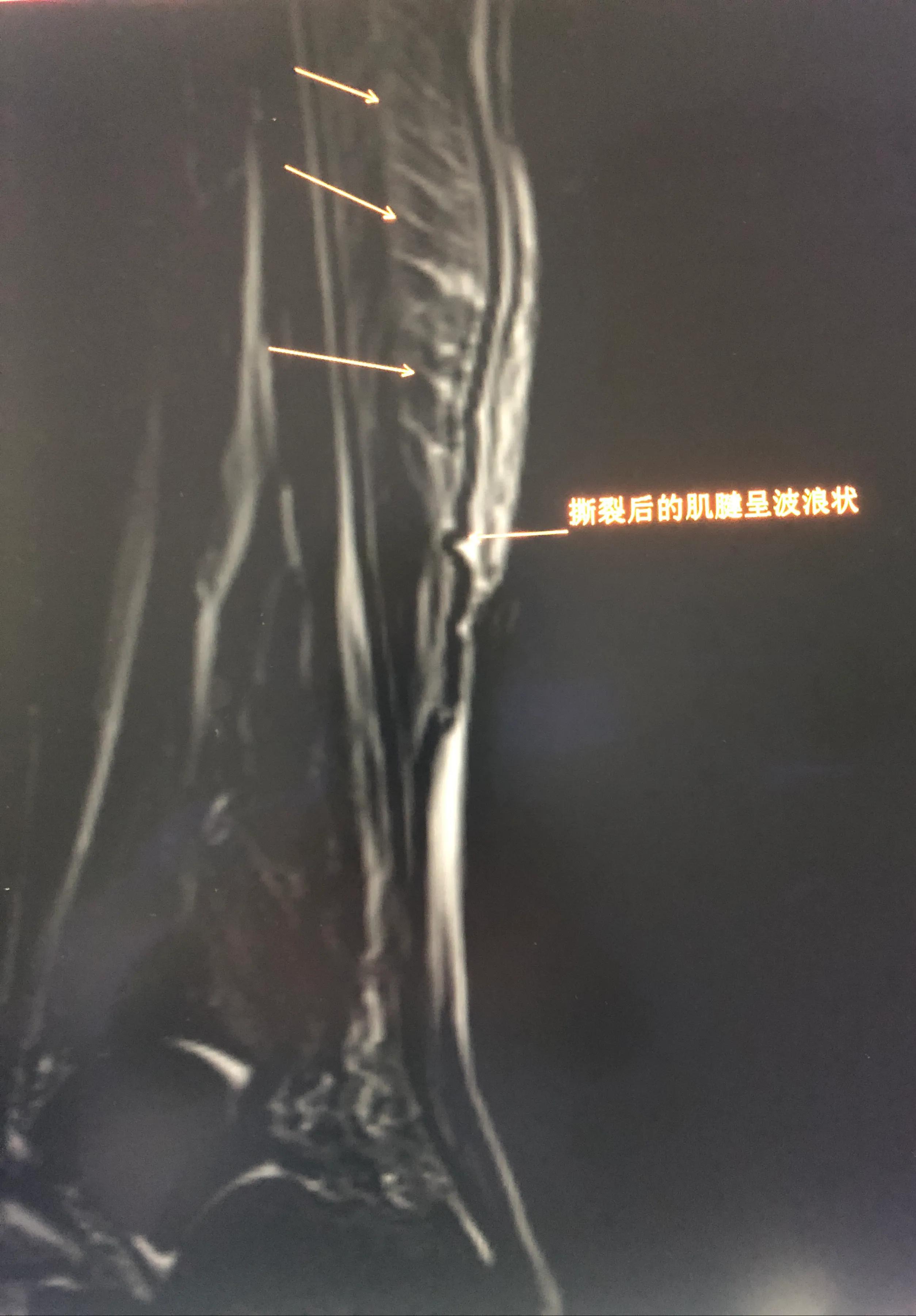 网球腿,网球肘肌腱撕裂