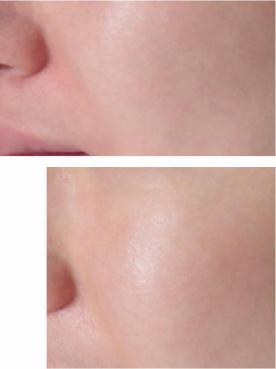 过敏祛痘推荐药品有哪些,过敏泛红爆痘怎么修复