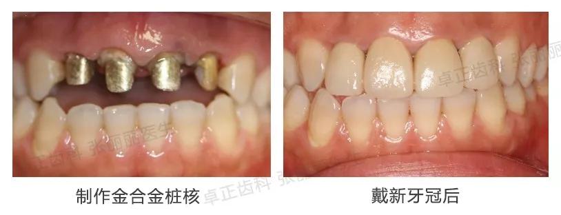 牙齿缺损全瓷冠修复多少钱,牙齿楔状缺损修复大概多少钱