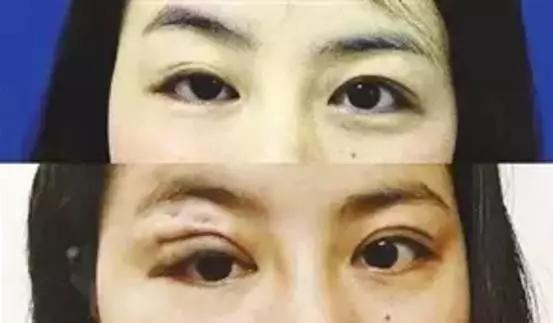 全切双眼皮修复过程经历真实,双眼皮失败修复费用由谁承担