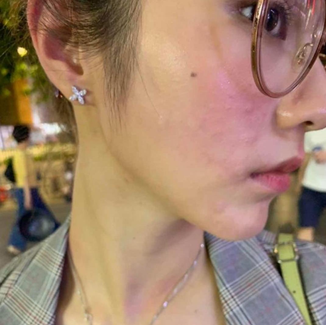 宅男女神邓月平戒口吃“草”曾荷尔蒙失调惹湿疹满身抓痕