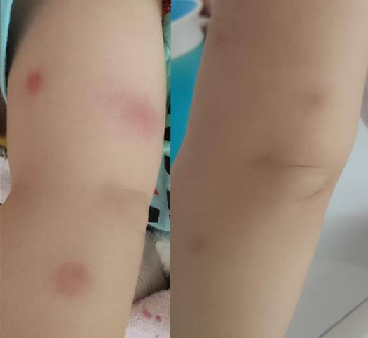 孩子被蚊子咬整个胳膊都肿了,蚊子把婴儿的手咬肿怎么治