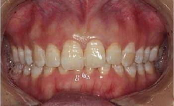 孩子牙齿不齐需要矫正吗,孩子牙齿不齐矫正有必要吗