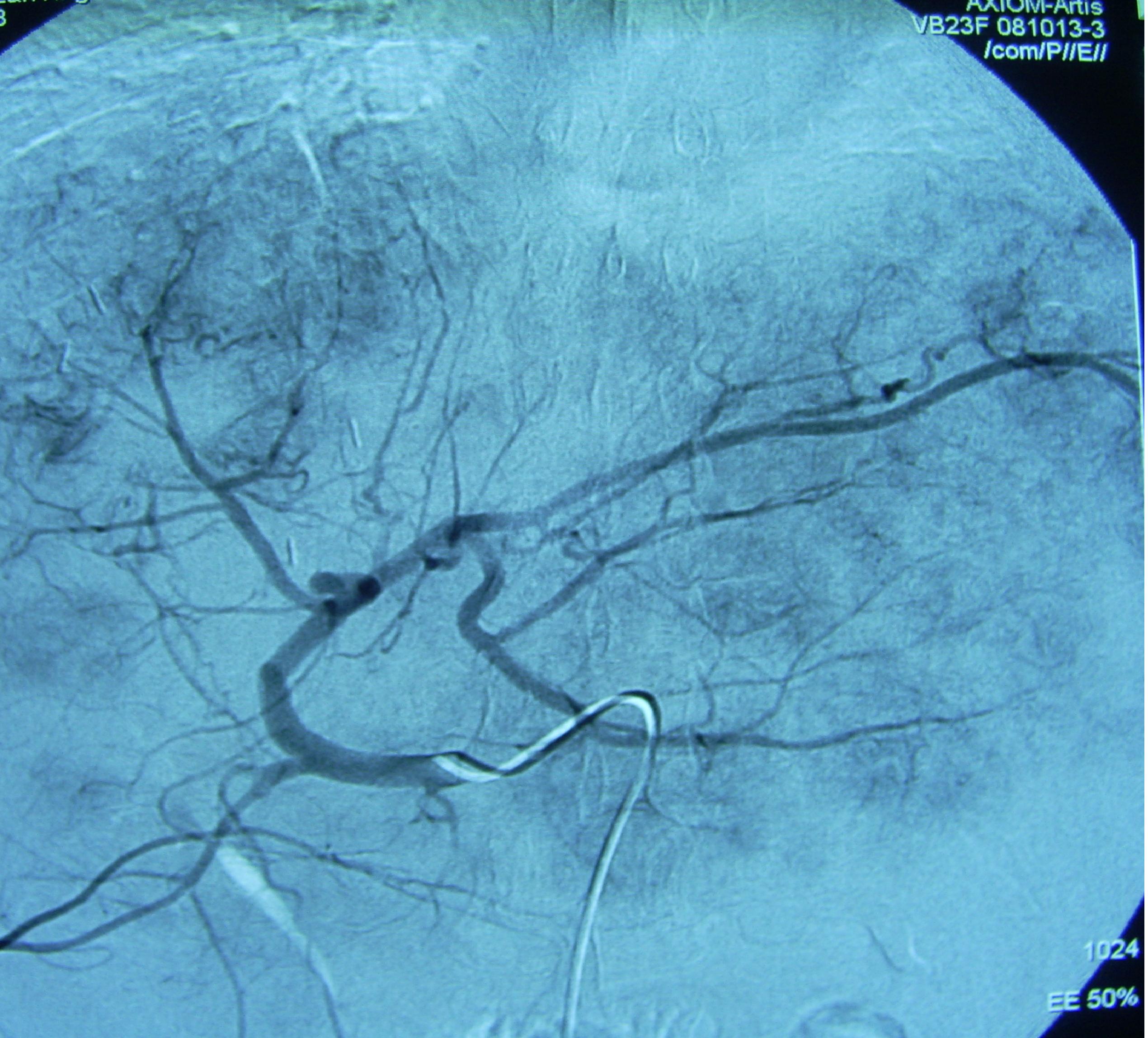 肝癌晚期保守治疗的成功案例,肝癌晚期治疗存活2年以上的案例