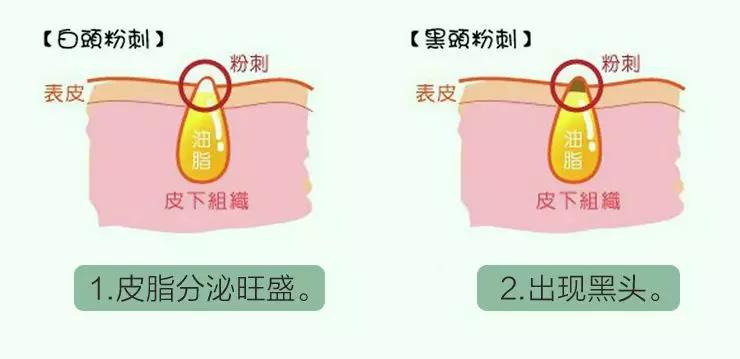 说说都如何治好痘痘的,一痘毁所有5个祛痘小技巧