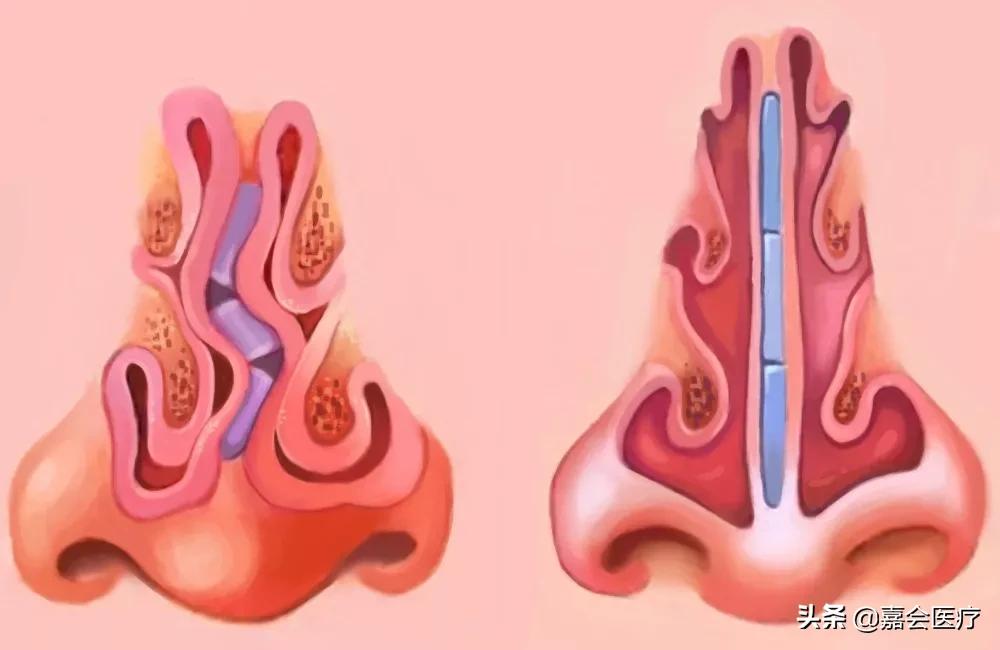 治好打鼾其实很简单的,通过手术能彻底治好打鼾吗