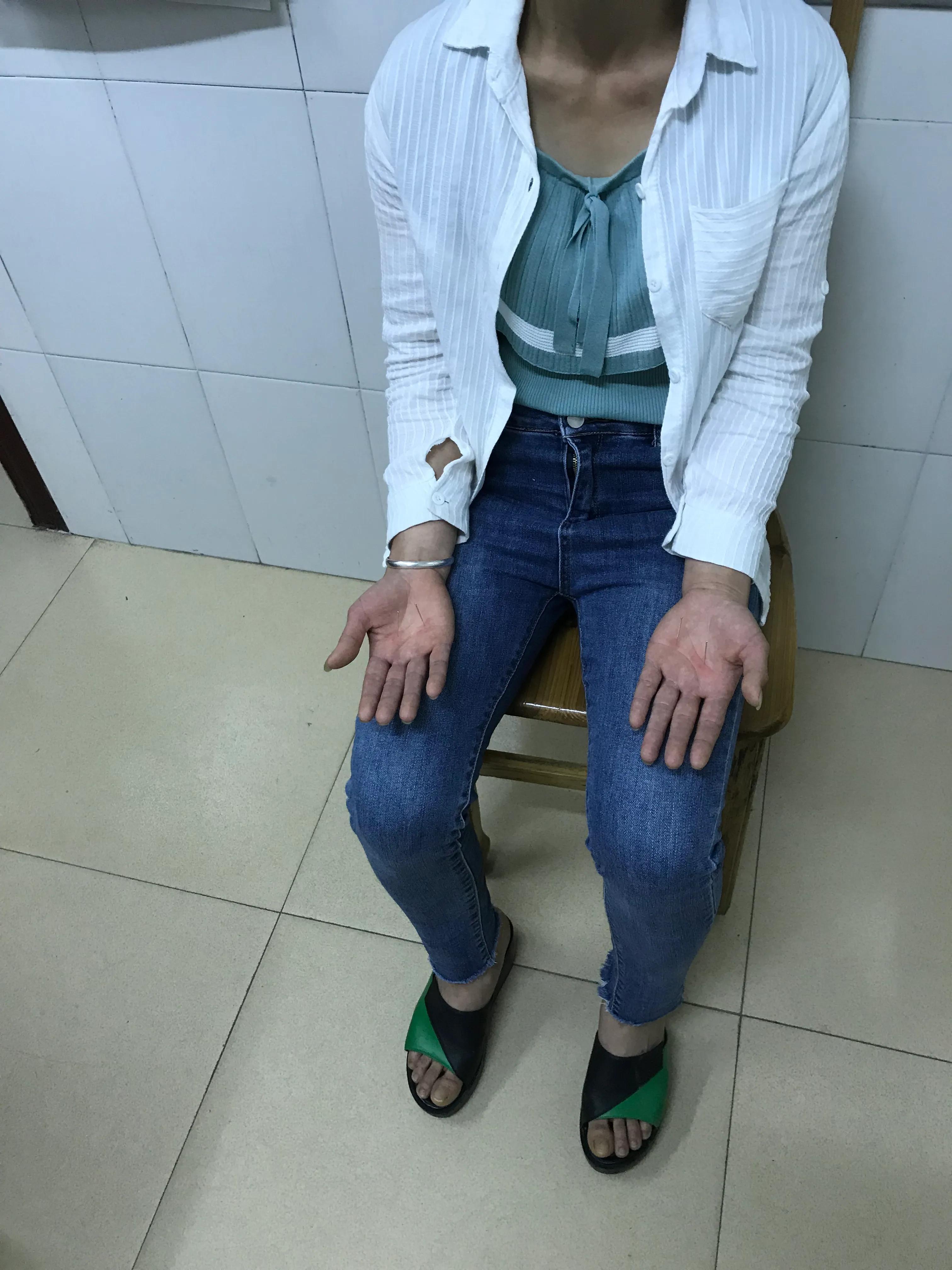 手脚心巨热头还疼,双足底麻痛是怎么回事