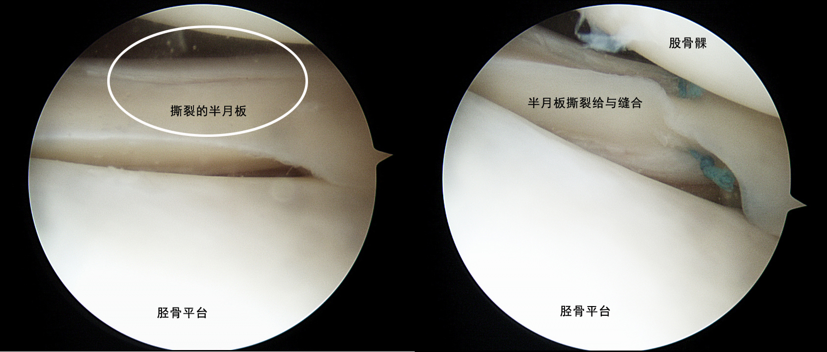 半月板撕裂手术后会有哪些症状,半月板撕裂时间长了可以做手术吗
