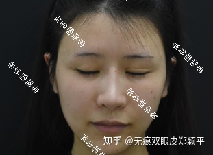 开扇双眼皮6毫米宽吗,双眼皮7.5毫米宽吗