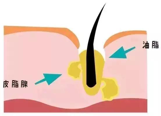 脸上毛孔粗大黑头粉刺多怎么改善,脸上都是黑头粉刺毛孔粗大怎么弄