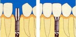种植牙科普知识海报,种植牙齿的冷知识