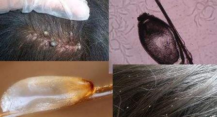 怎么去除头上的虱子和虱子卵,头上长虱子有什么办法除掉虱子