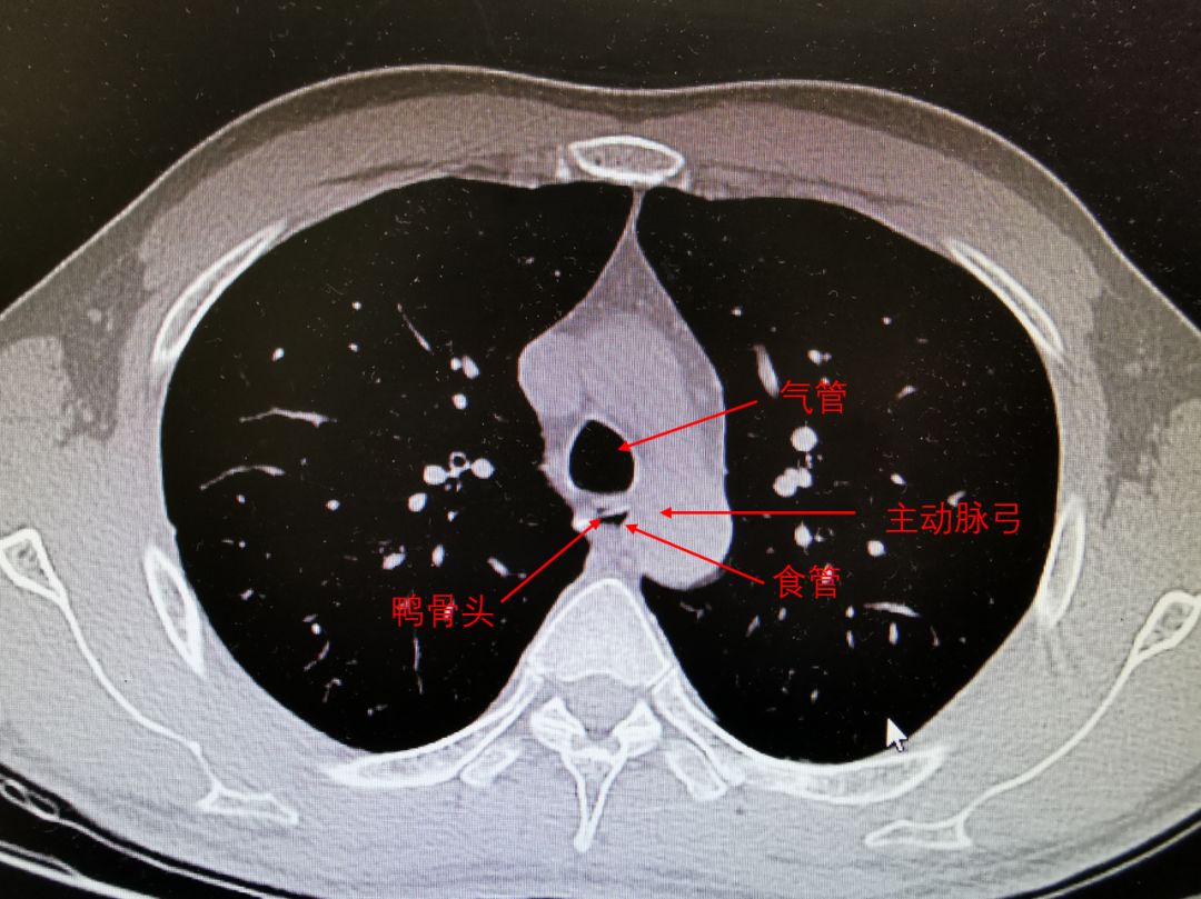 一只鸭引发血案,一只鸭引发的血案