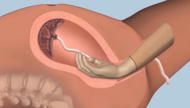 手剥胎盘和宫颈撕裂哪个疼,手剥胎盘和剖腹产哪个更疼