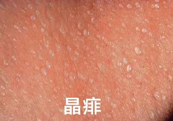 爽身粉去痱子,爽身粉止痒祛痱成人