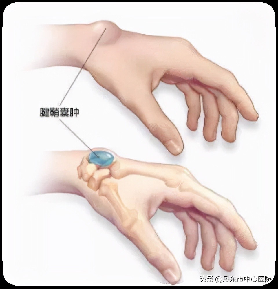 医学科普腱鞘囊肿骨科,健康科普知识大全骨科