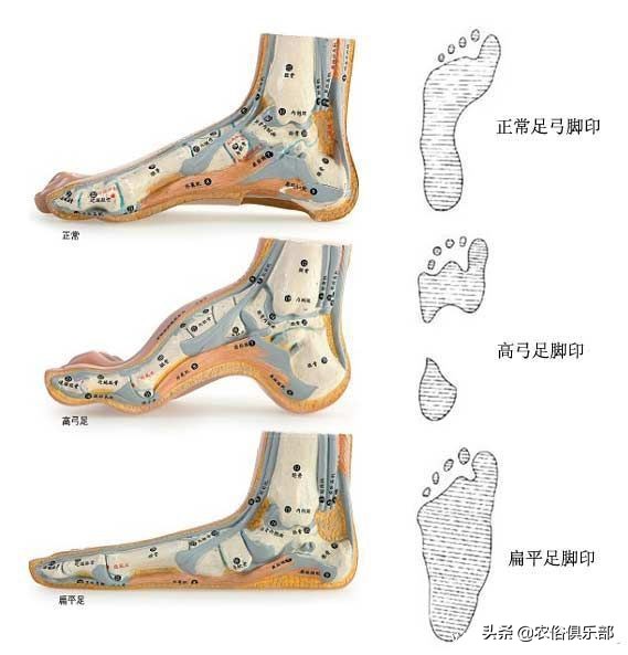 农村俗语：脚板下无空，是个老长工！平板脚真的不好么？